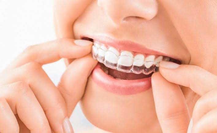 Applicazione di un allineatore trasparente