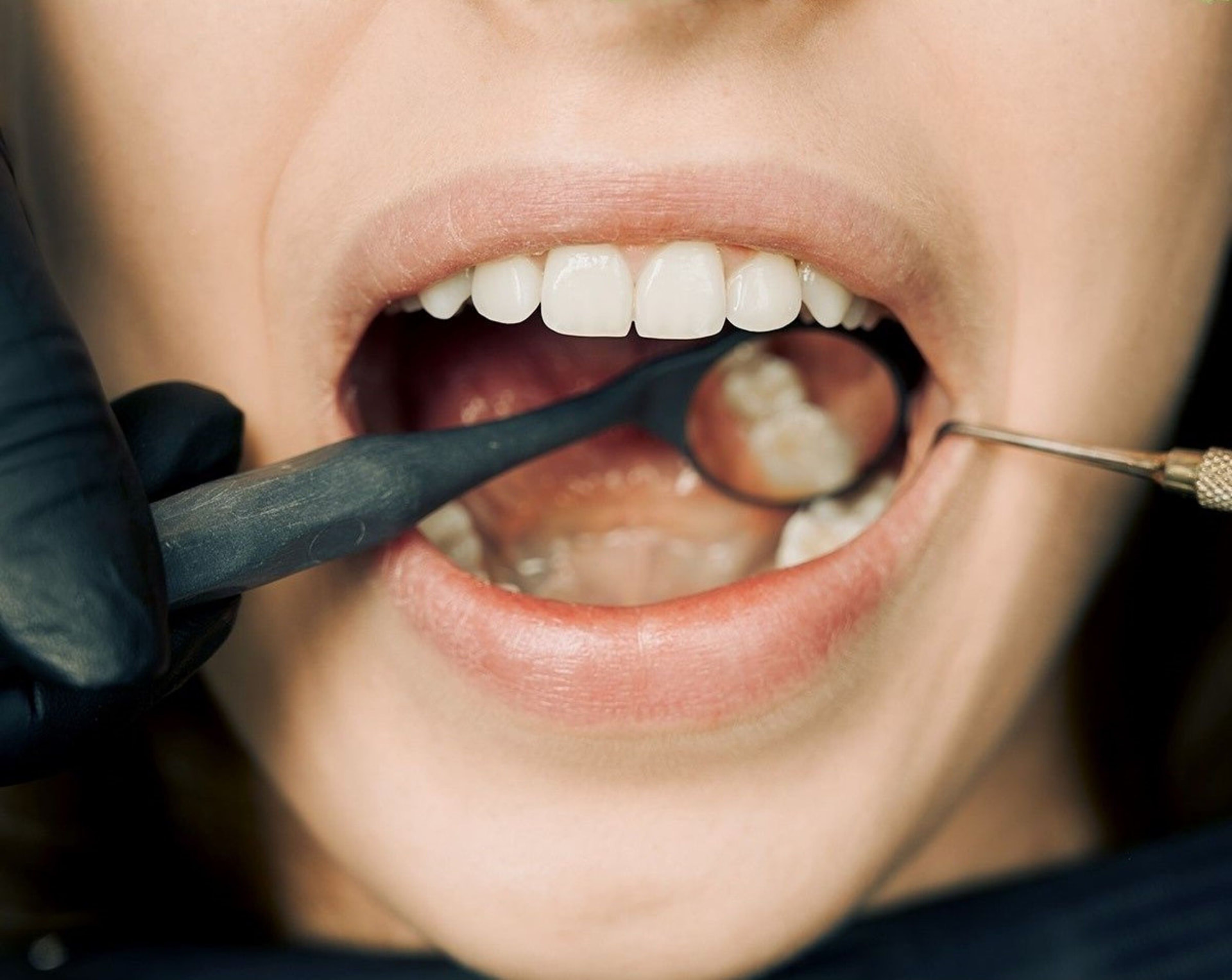 Controllo odontoiatrico dei tessuti gengivali