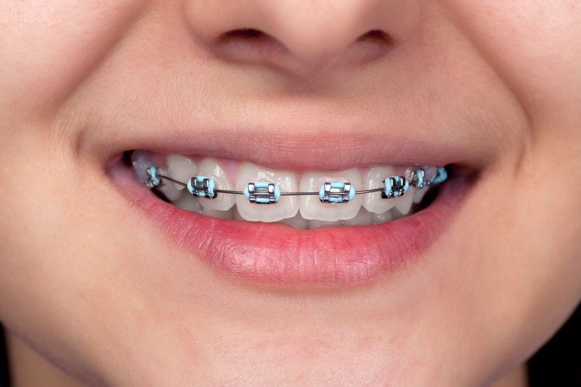 Sorriso con apparecchio ortodontico fisso