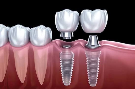 Illustrazione di impianti dentali con corona