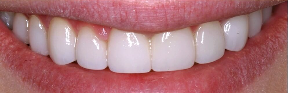 Sorriso prima e dopo il trattamento estetico